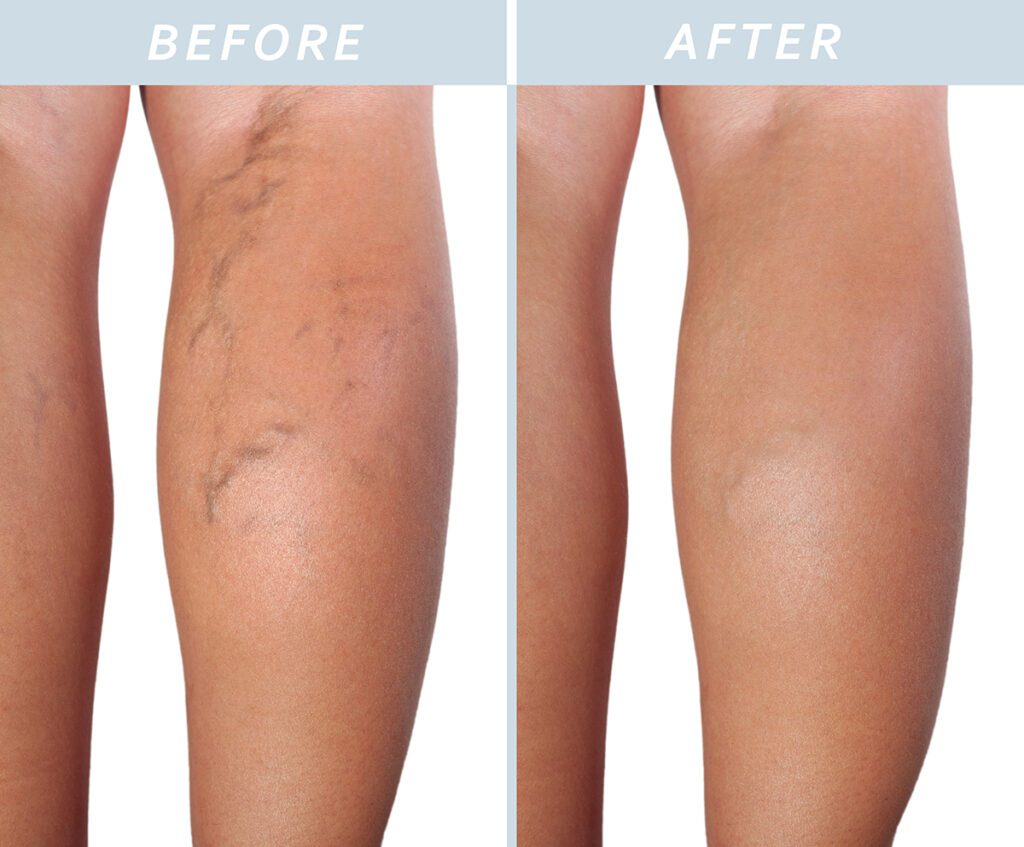 Treatment of varicose veins before and after.